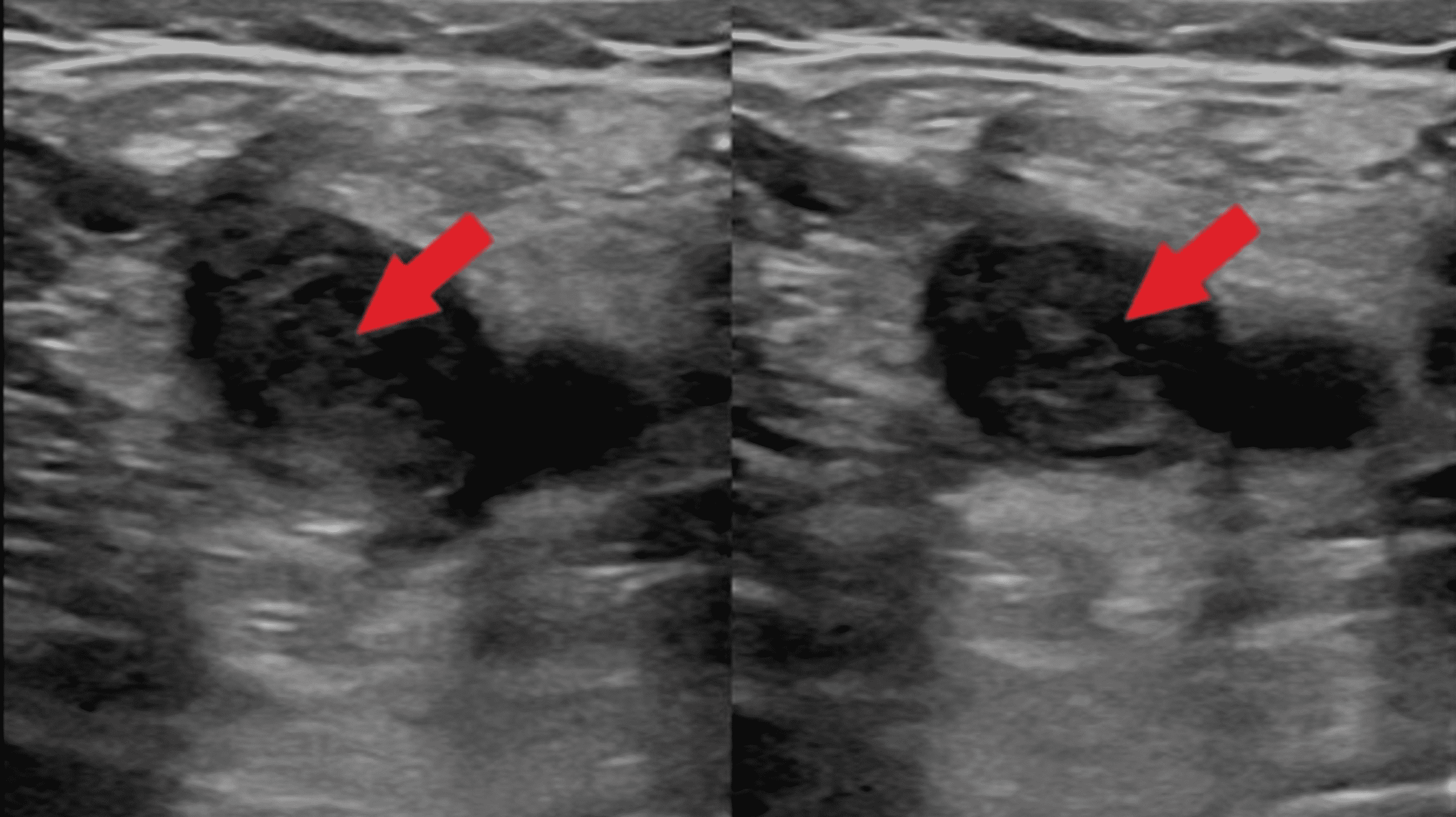 Venous Thromboembolism and Thymic Hyperplasia in the Setting of Silent
