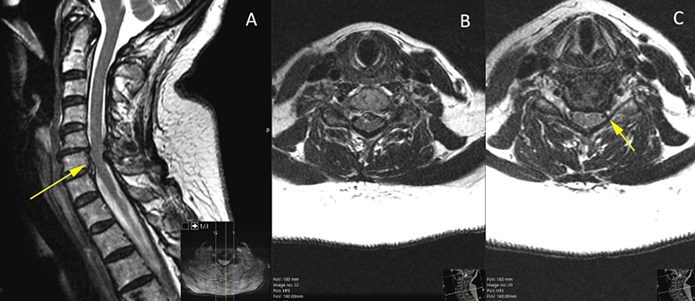 Surgical Treatment of Propriospinal Myoclonus: A Case Report | Cureus