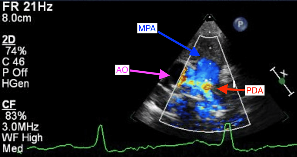 -Echocardiography-parasternal-short-axis-view-at-the-aortic-valve-level-with-color-flow-doppler-showing-turbulent-flow-of-PDA-(yellow-mosaic-signals)-with-left-to-right-shunting.