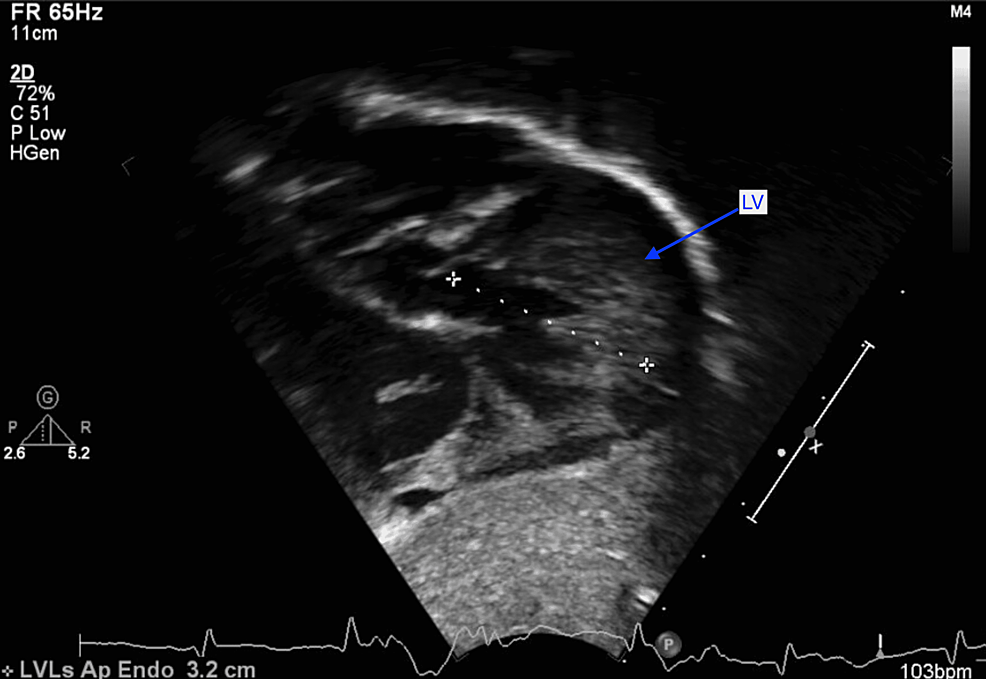 The-left-ventricle-(LV)-is-moderately-dilated-with-mild-hypertrophy.-The-LV-appears-to-be-hypertrabeculated,-and-measurements-of-the-noncompacted:compacted-zones-meet-criteria-(>2:1)-for-noncompaction