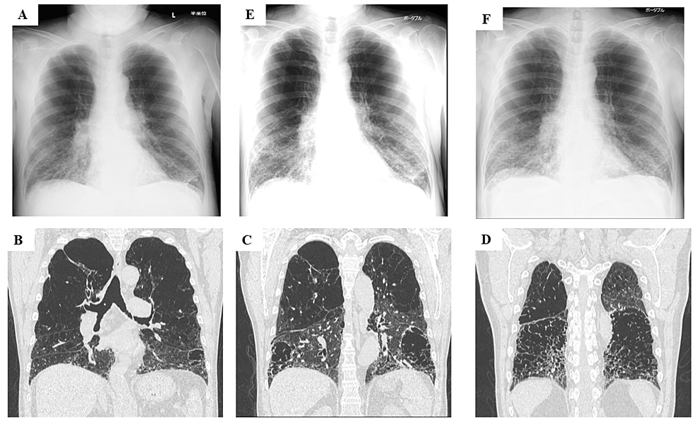 Experience With the Use of Baricitinib and Tocilizumab Monotherapy or  Combined, in Patients With Interstitial Pneumonia Secondary to Coronavirus  COVID19: A Real-World Study