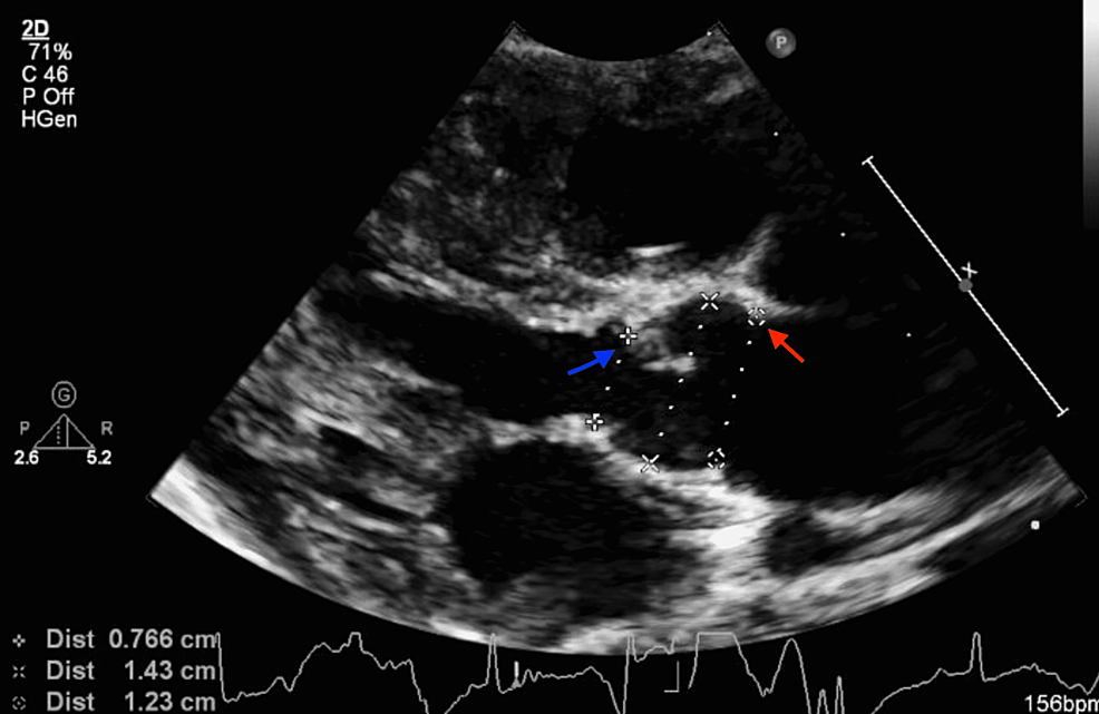 Transthoracic-echocardiogram-long-axis-view-showing-left-ventricular-outflow-tract,-aortic-valve-area-(red-arrow),-and-sub-aortic-membrane-(blue-arrow)