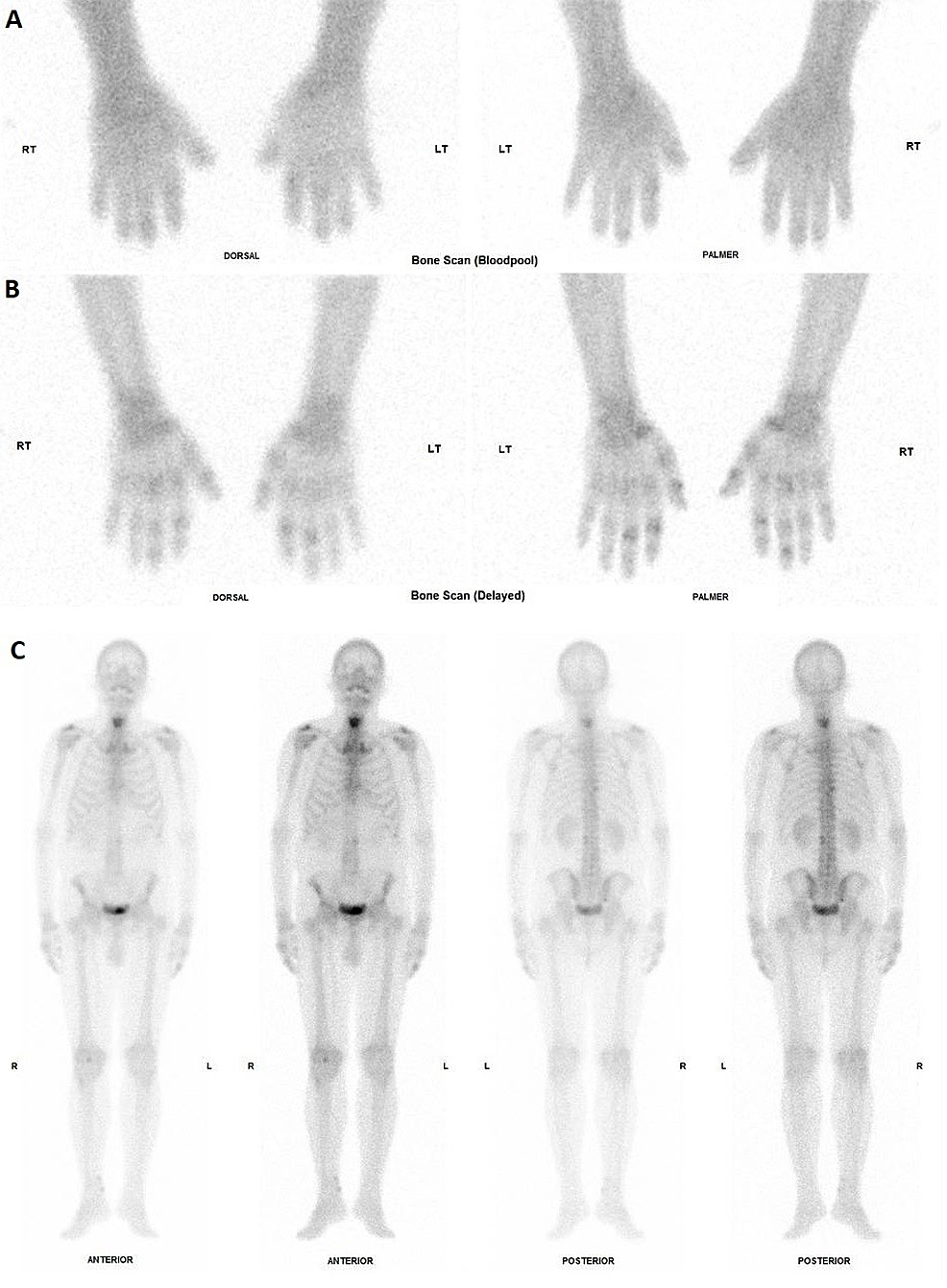 Triphasic-bone-scan-images-showing-(A)-symmetrically-increased-radiotracer-uptake-in-both-hands-in-the-blood-pool-phase,-(B)-increased-peri-articular-radiotracer-uptake-in-the-small-joints-of-the-hands,-and-(C)-more-prominent-radiotracer-activity-in-the-hands-compared-to-the-lower-limbs-and-other-major-joints.