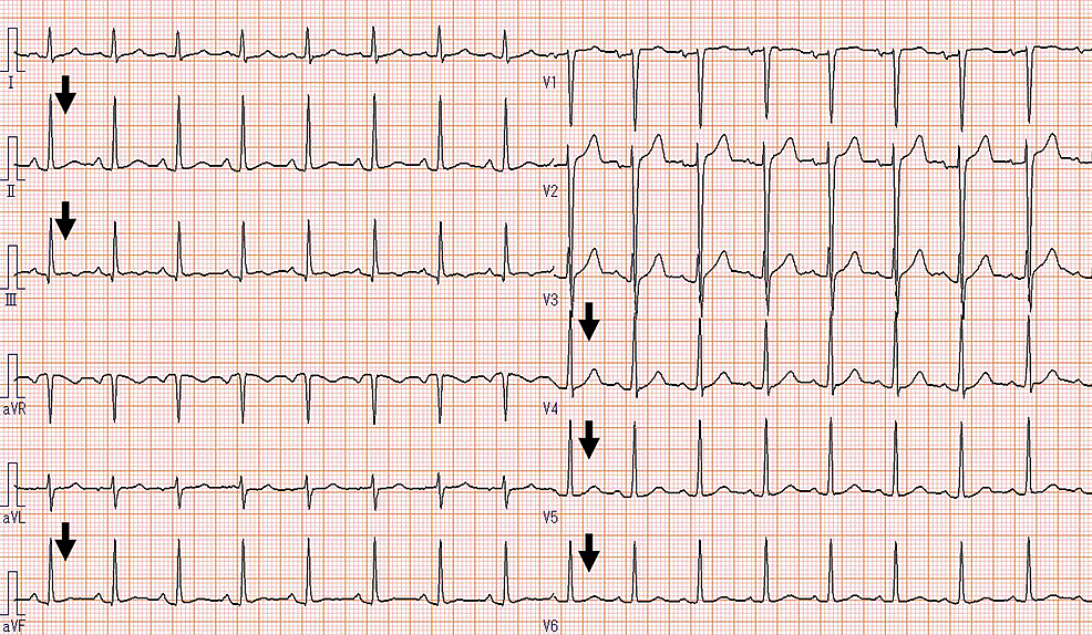 Electrocardiogram-showing-ST-segment-normalization-in-the-II,-III,-aVf,-and-V4–6-leads.