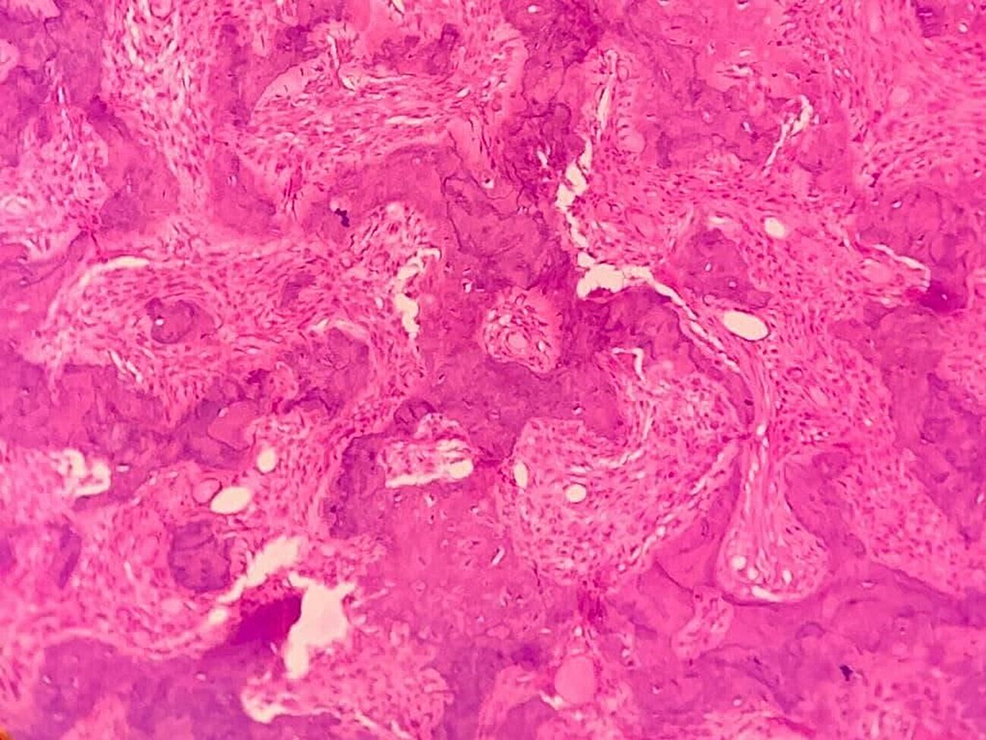 Cureus An Uncommon Presentation Of Ossifying Fibroma In The Maxilla