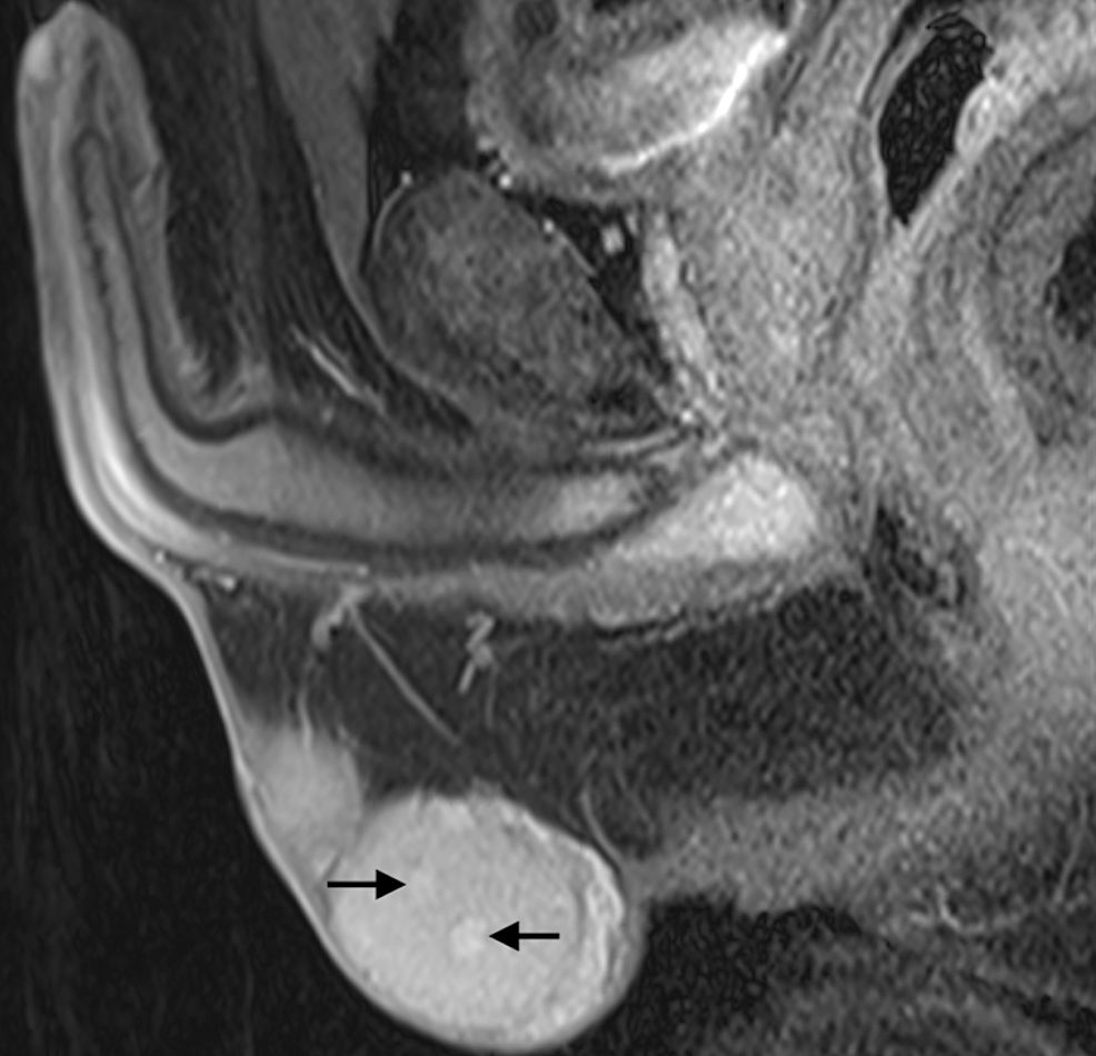 T2-weighted-MRI-shows-multiple-nodular-lesions-below-6-mm-in-size,-with-weak-heterogeneous-contrast-uptake-with-arrows.