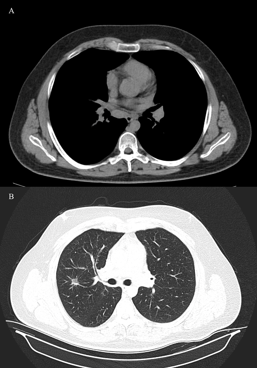 Thoracal-CT-shows-the-regression-in-the-size-of-the-nodules-in-the-lungs-(A)-and-the-mediastinal-lymphadenopathies-(B)-after-high-dose-steroid-treatment.