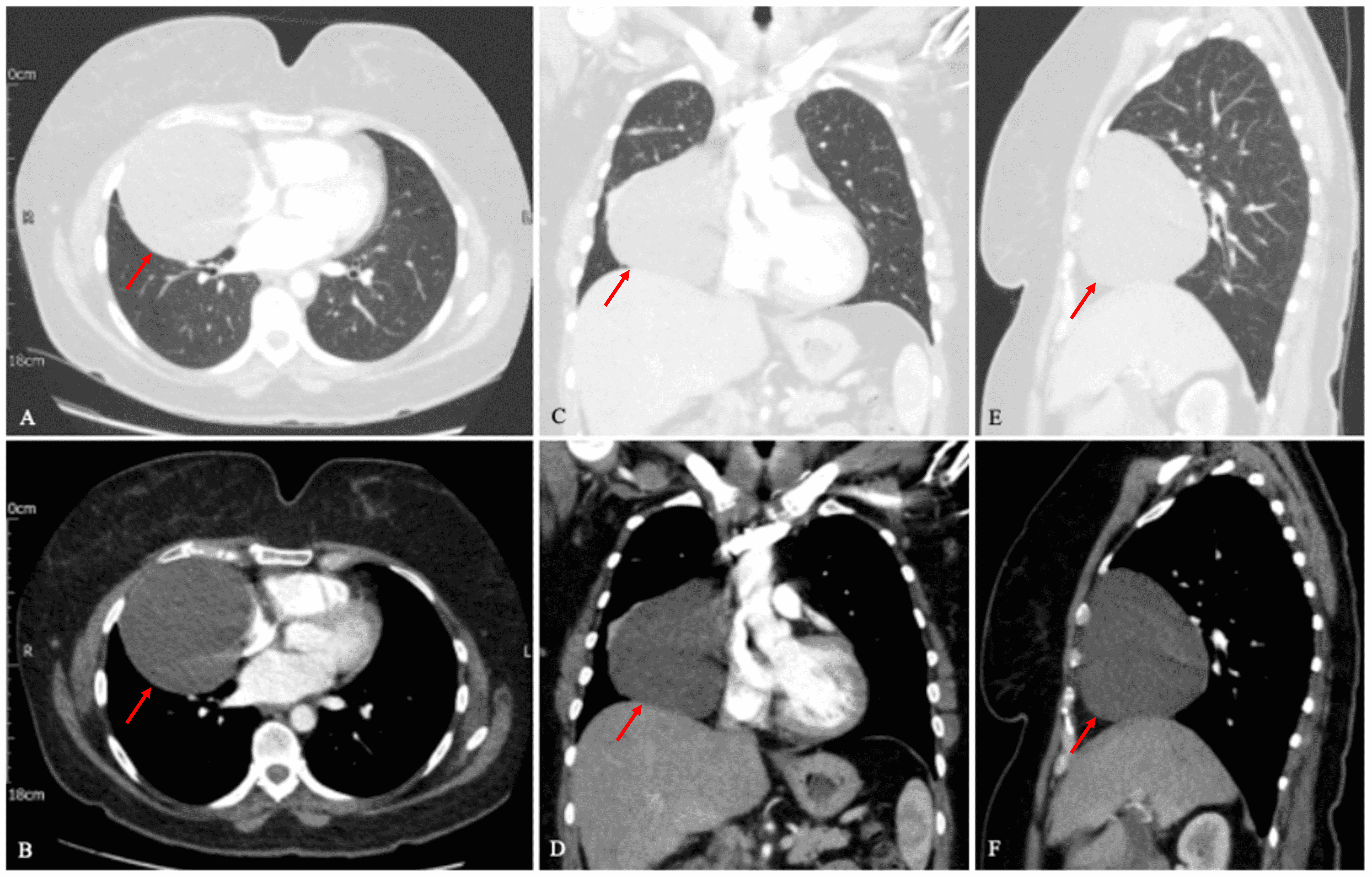 Cureus An Incidental Finding Of A Large Pericardial Cyst