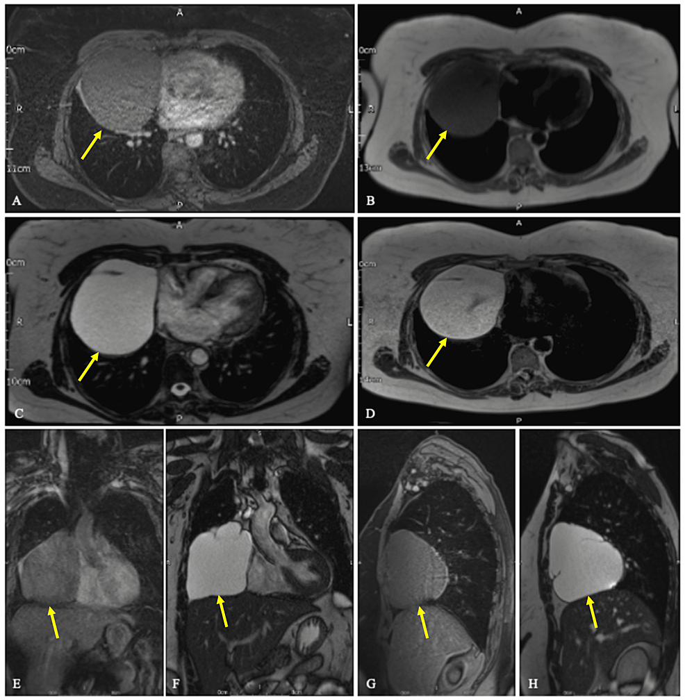 Cureus An Incidental Finding of a Large Pericardial Cyst