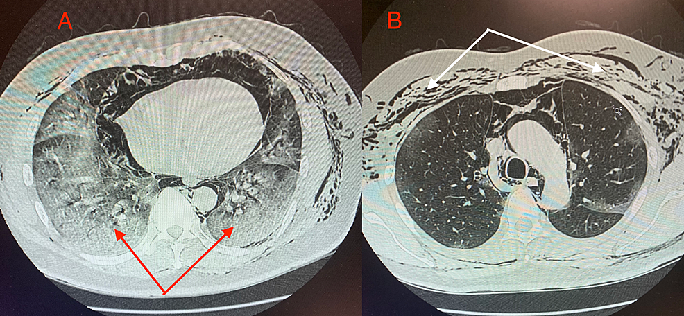 Cureus St Segment Elevation Secondary To Spontaneous