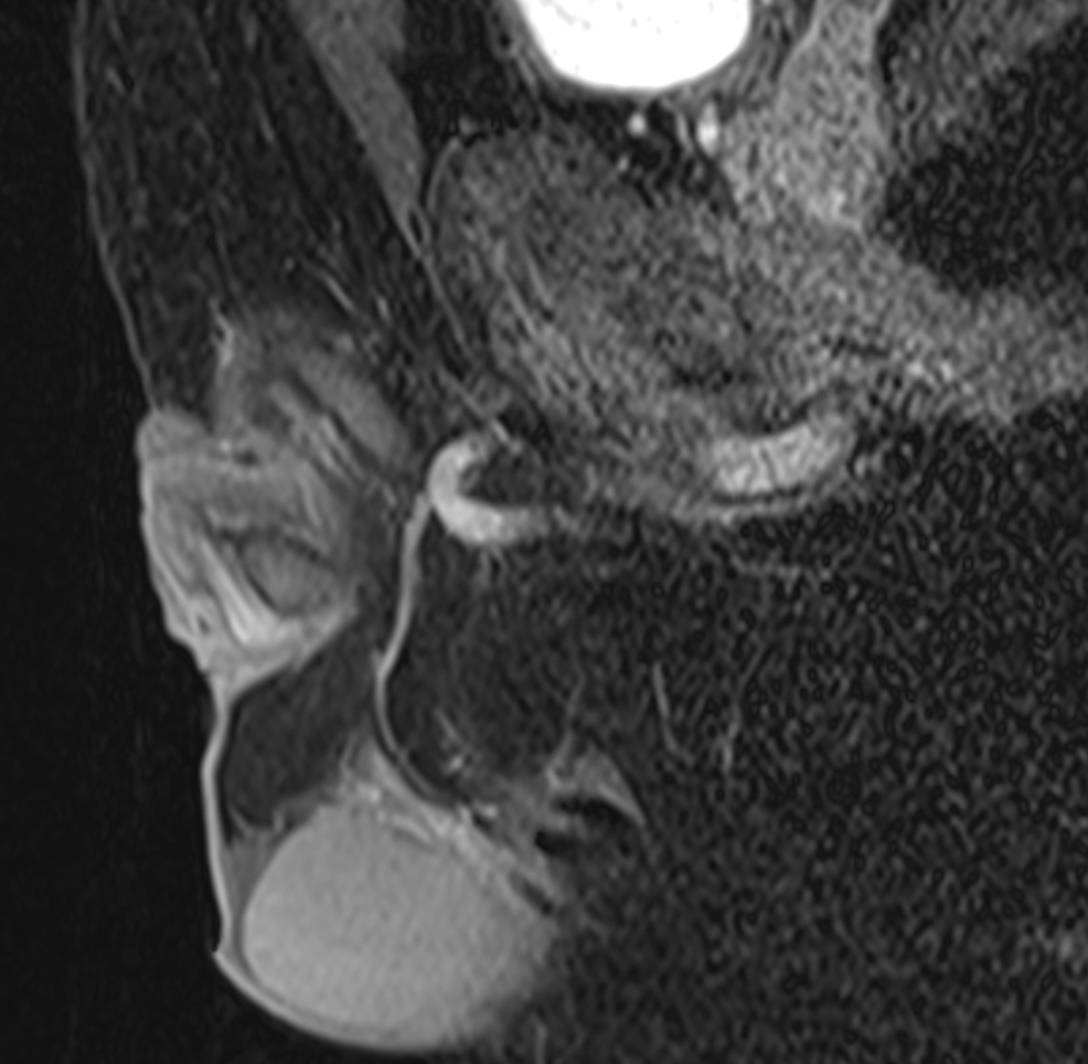 Cureus Sarcoidosis With Bilateral Testicular Involvement Resembling Testicular Cancer A Rare 8811