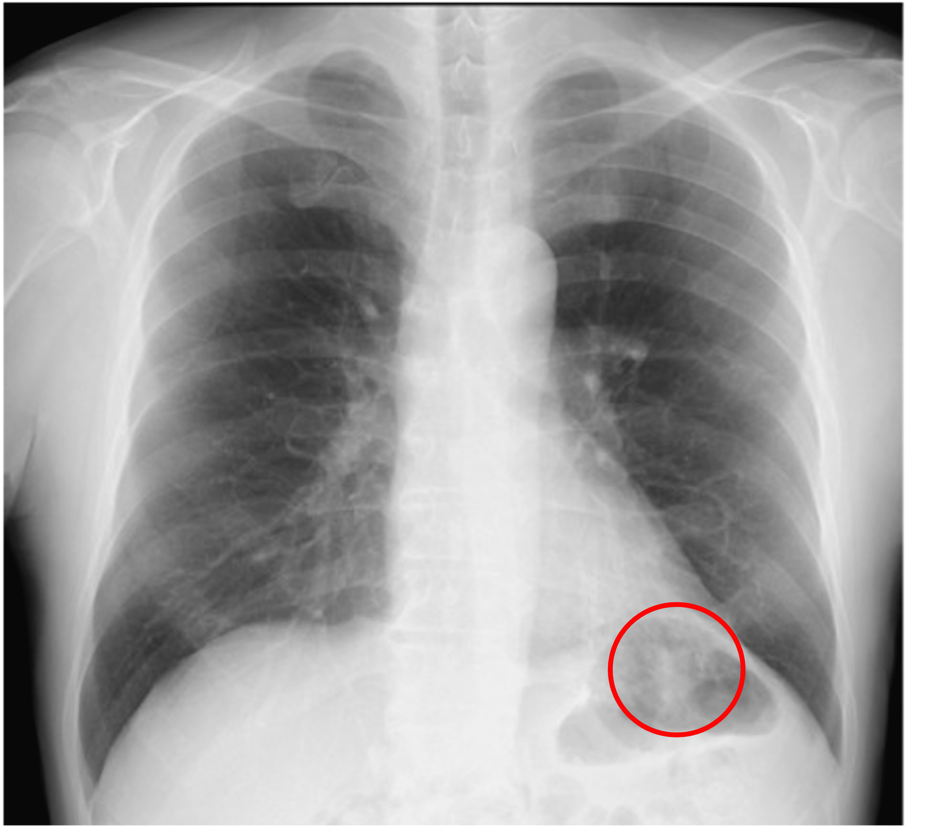 Cureus | A Case of Asymptomatic Pulmonary Nocardia cyriacigeorgica ...