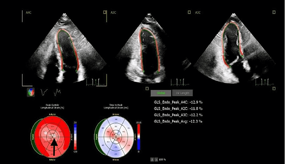 Cureus | Abnormal Longitudinal Strain in Takotsubo Cardiomyopathy: A ...