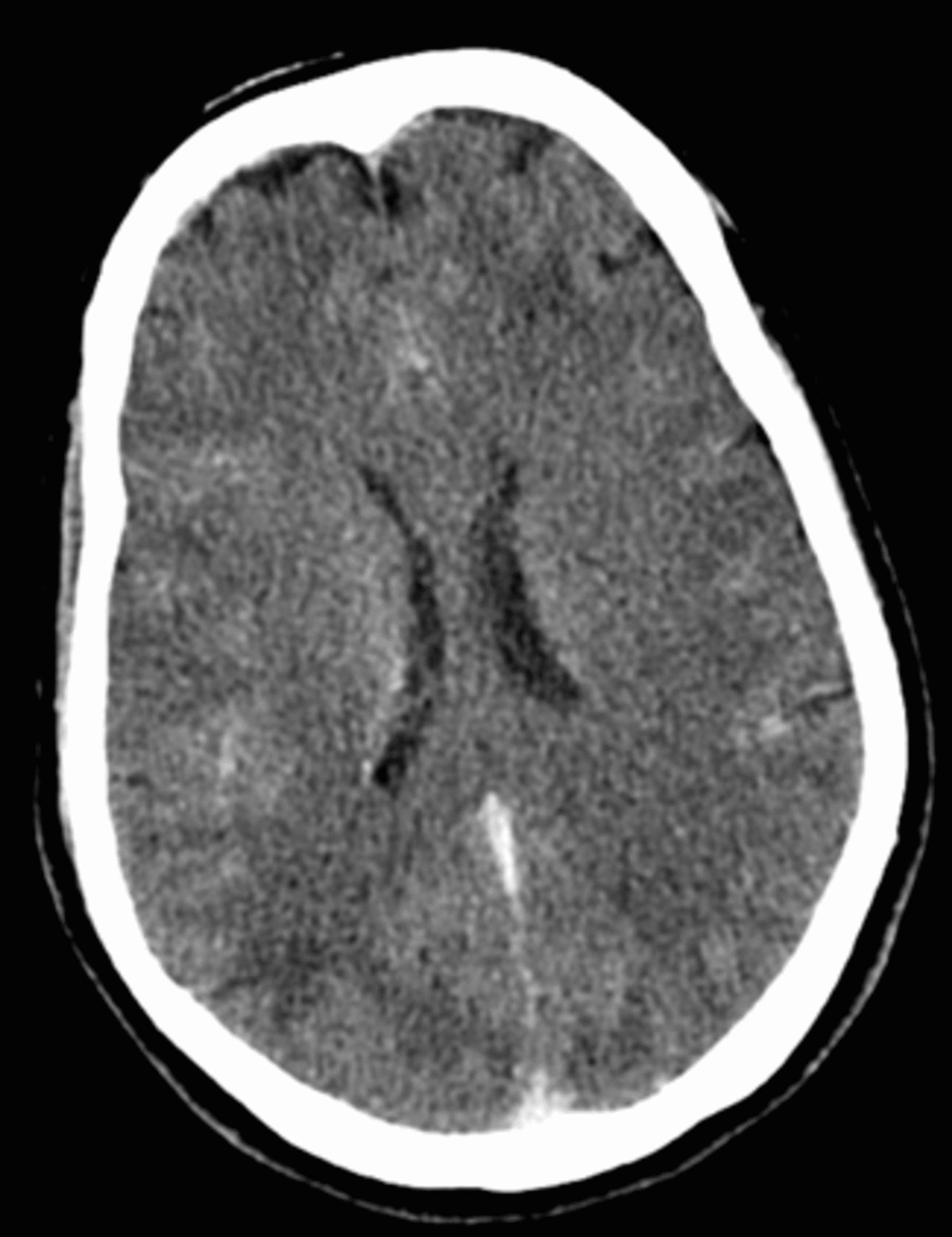 Cureus | A Common Neurological Presentation With an Unusual Etiology ...