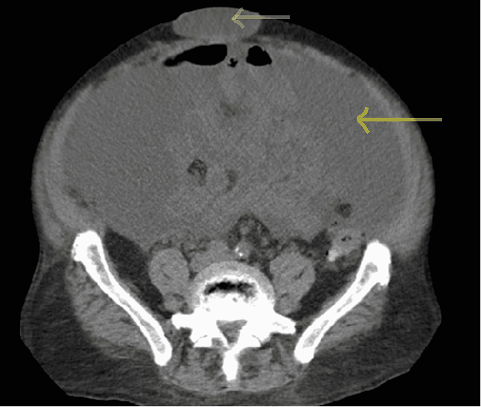 CT-scan-of-the-abdomen-with-IV-contrast-after-paracentesis