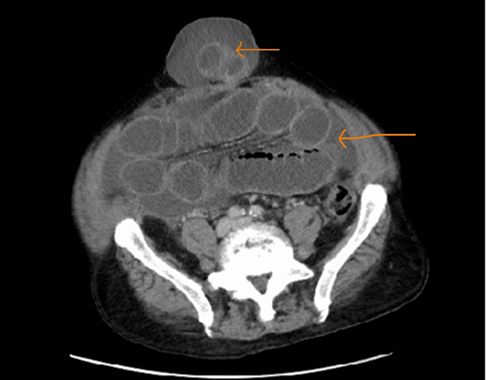 CT-scan-of-the-abdomen-without-contrast-on-admission-prior-to-abdominal-paracentesis