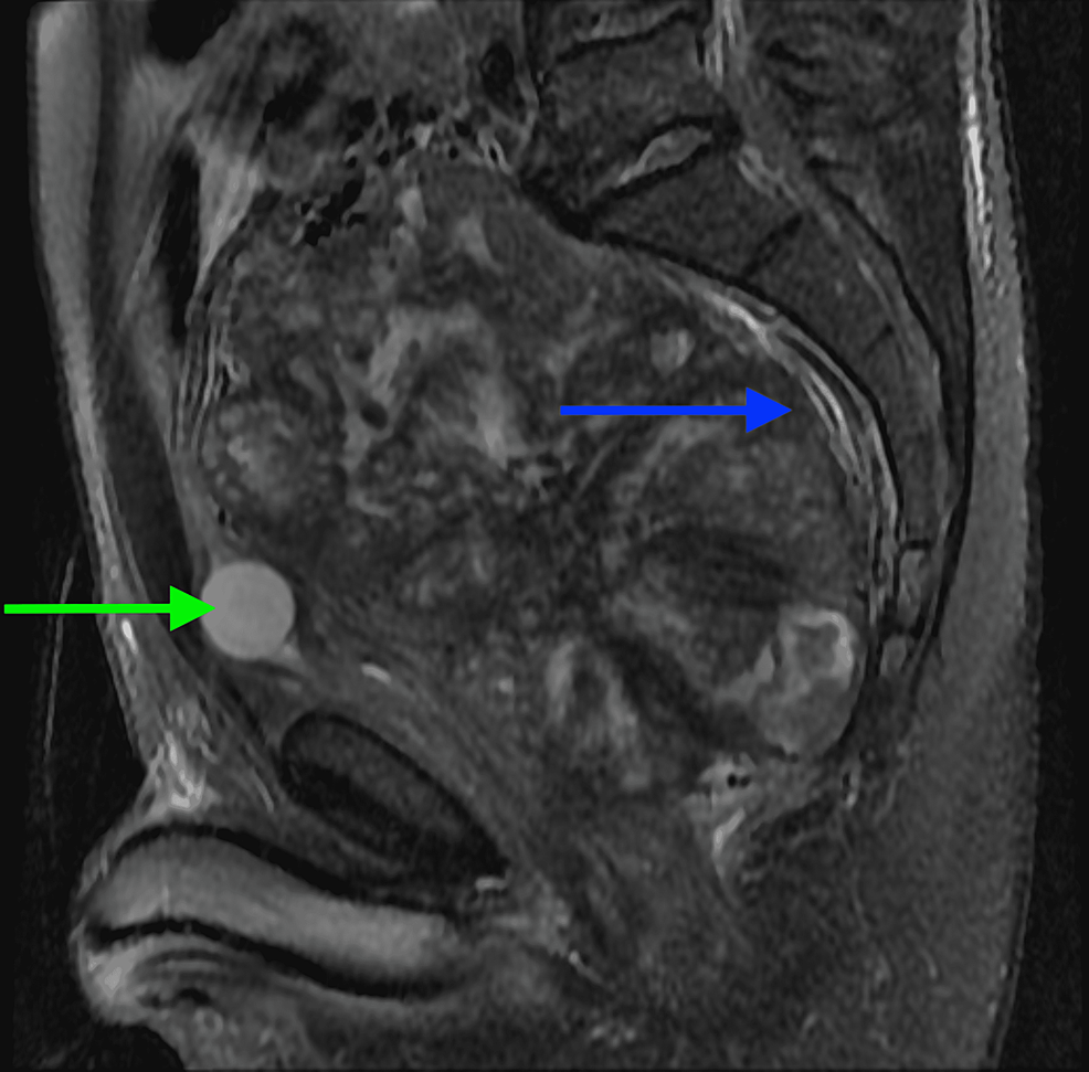 Cureus A Rare Case Of A Pelvic Solitary Fibrous Tumor