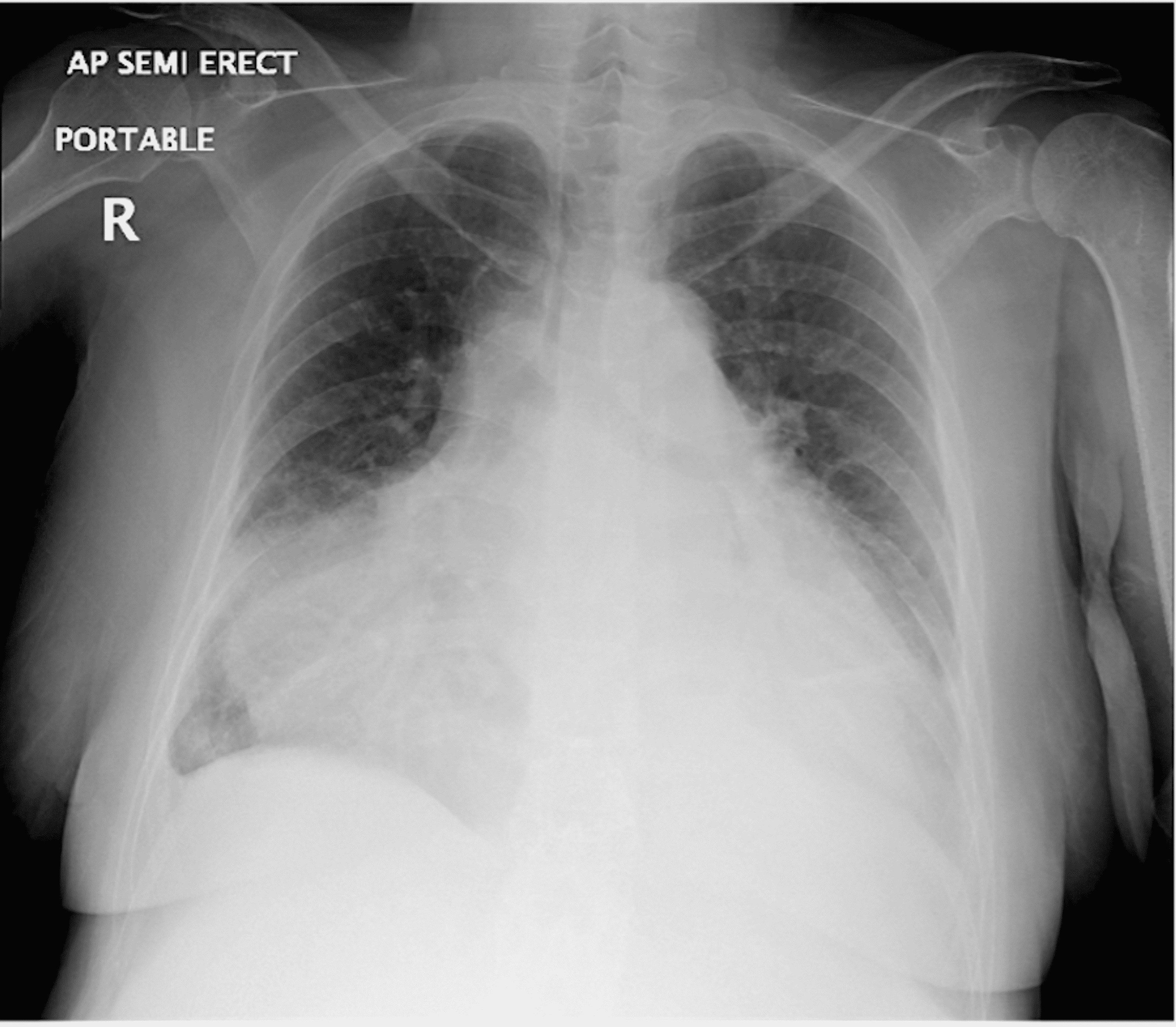 Cureus | Clinically Ambiguous Hemorrhagic Cardiac Tamponade Associated ...