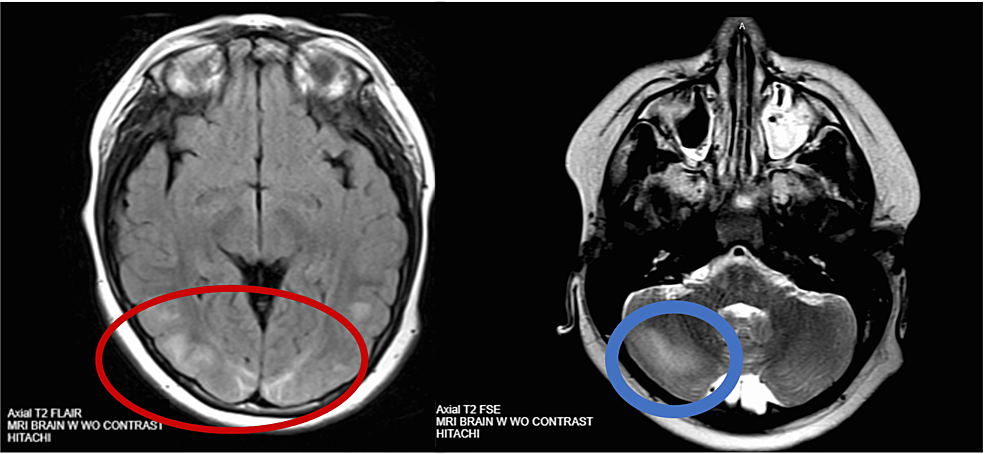 Brain-T2-magnetic-resonance-imaging-without-contrast.