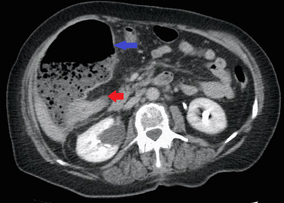 CT-abdomen/pelvis-