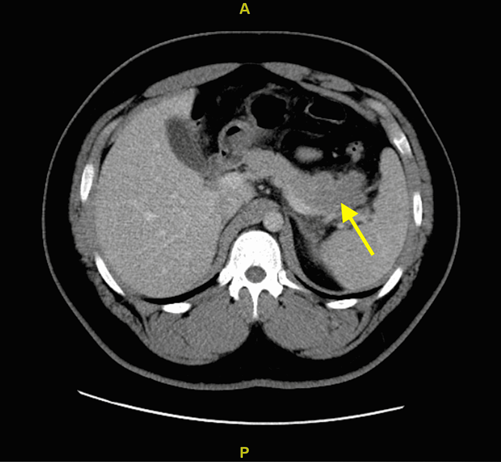 An Unusual Case of Isolated Pancreatitis Secondary to Blunt Abdominal ...