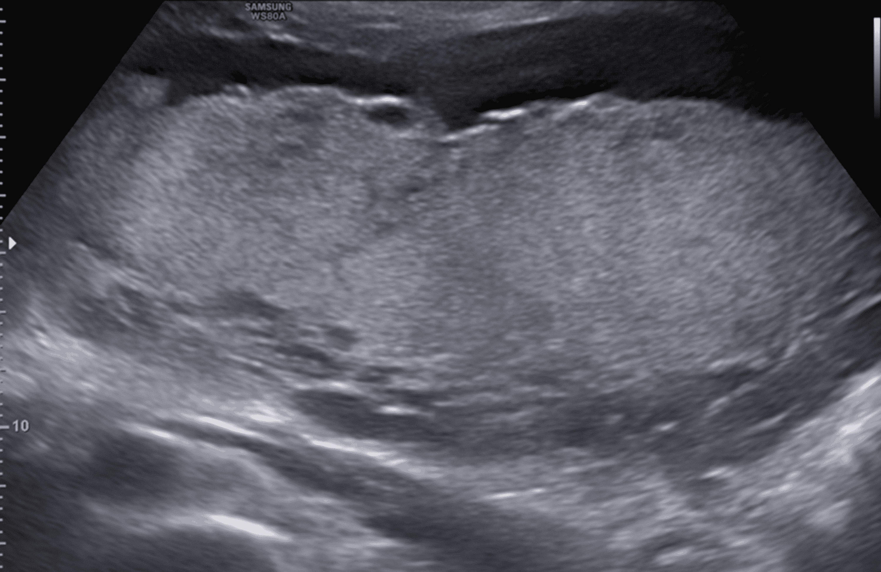 Cureus | Placental Ultrasonographic Findings Due to COVID-19 Infection ...