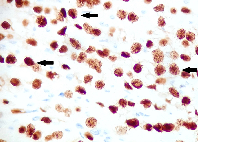Immunohistochemistry-for-estrogen-receptor