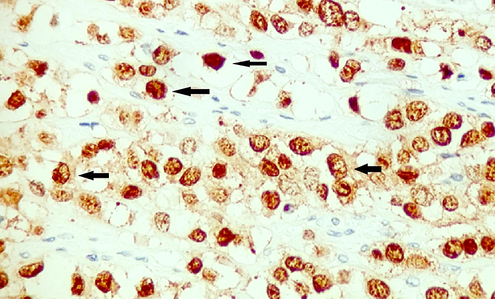 Immunohistochemistry-for-GATA-3