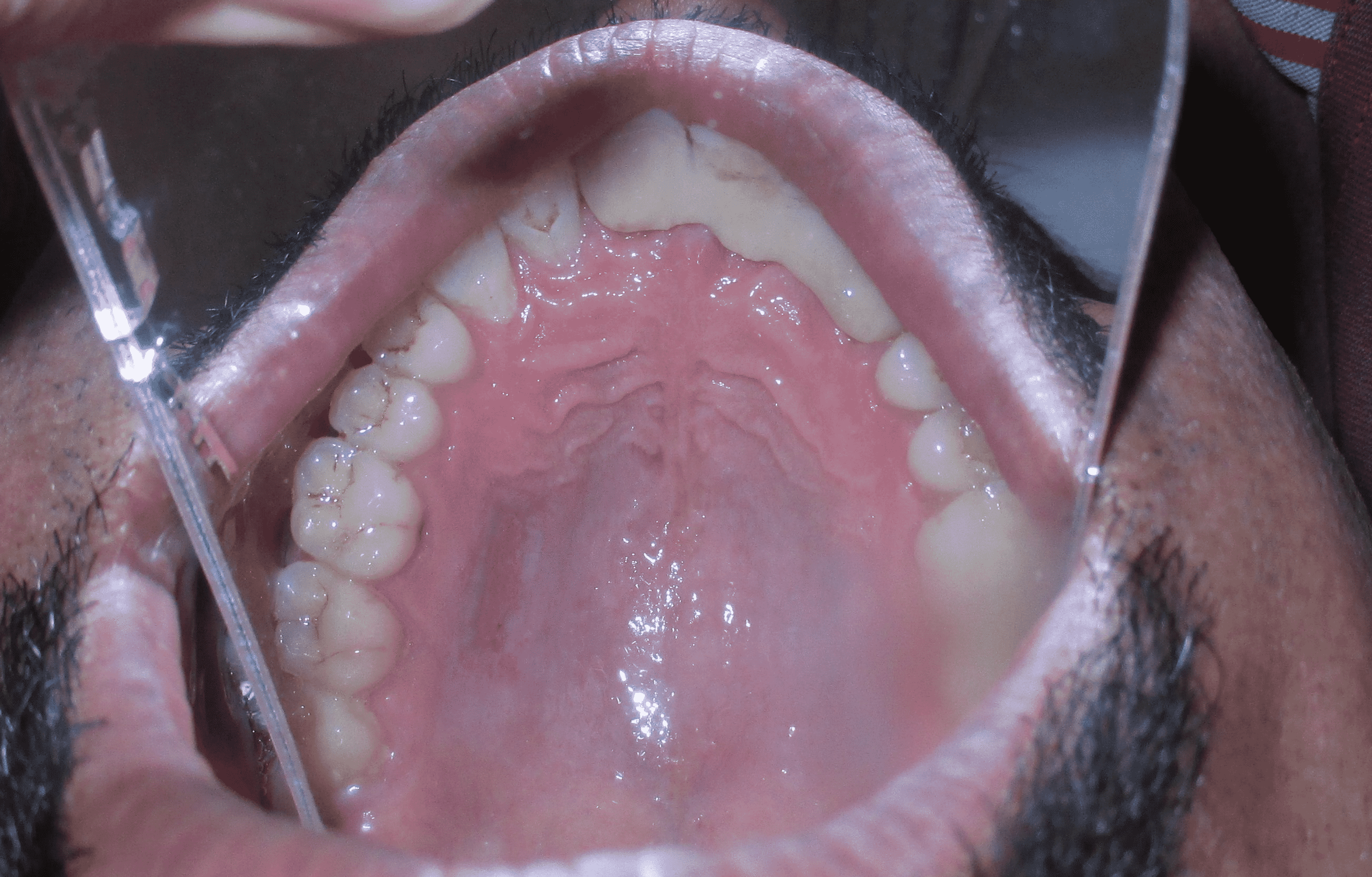 Cureus Enhancing Gingival Phenotype With Vestibuloplasty and Free