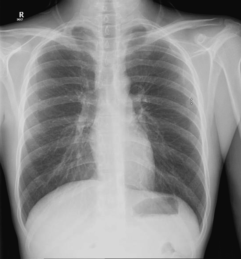 Cureus | Parotid Gland Tuberculosis: A Case Report and Literature Review