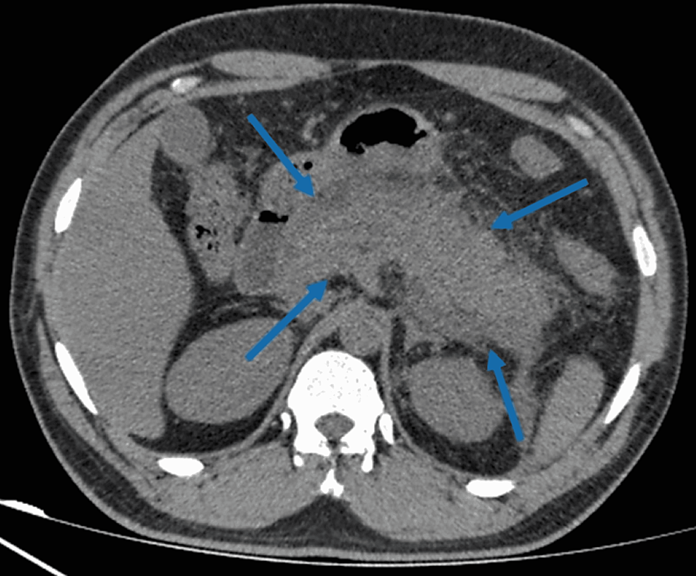 CT-abdomen-demonstrating-diffuse-inflammation-of-the-pancreas-with-ill-defined-borders-(blue-arrows).