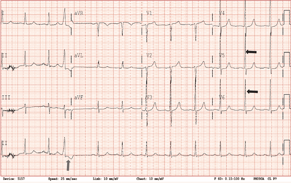 Crescendo Angina Secondary to Congenital Absence of the Left Circumflex ...