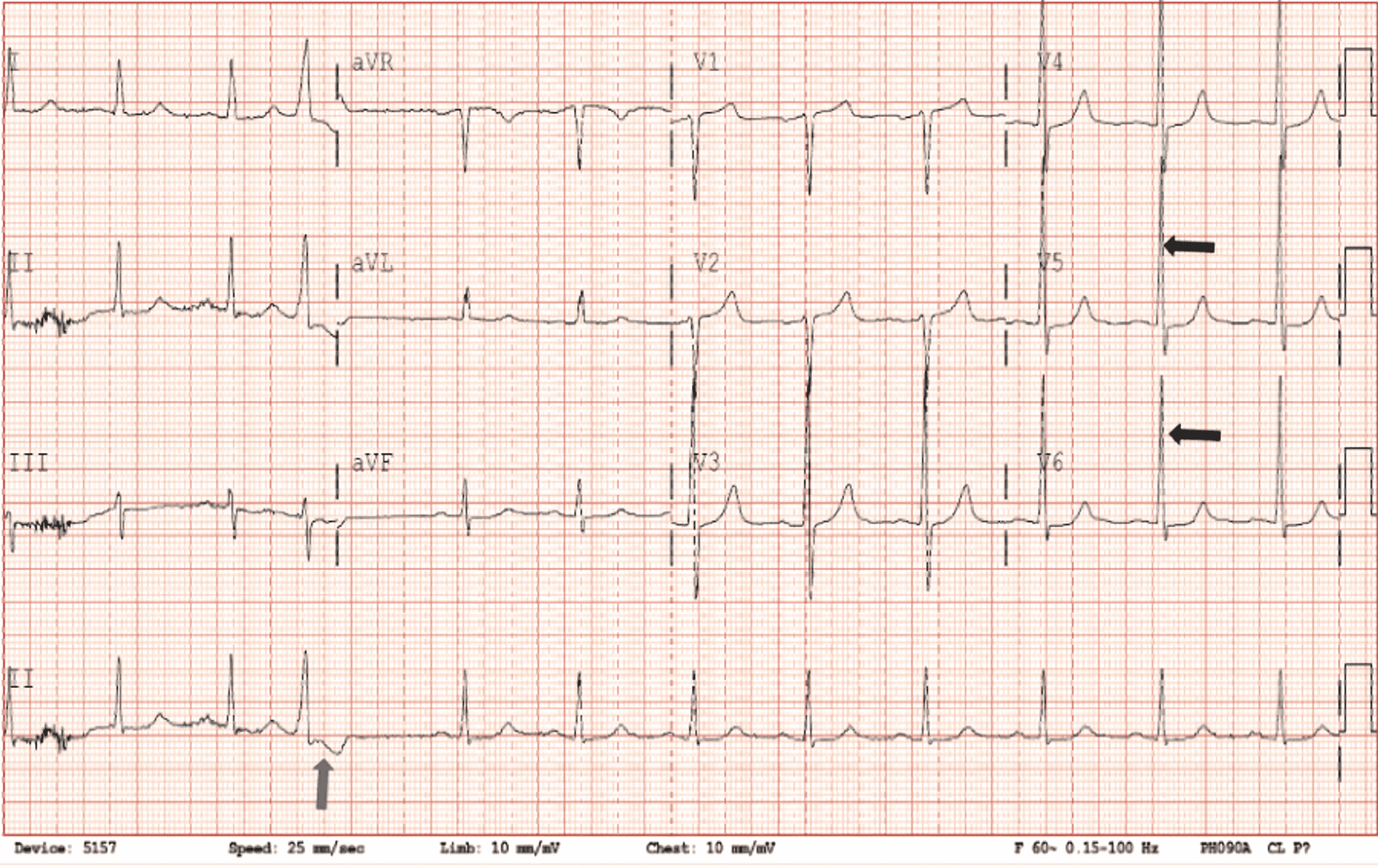 Cureus | Crescendo Angina Secondary to Congenital Absence of the Left ...