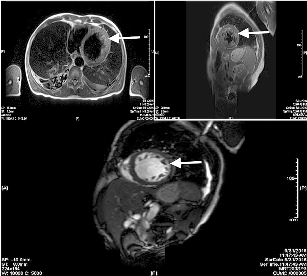 Southwest Journal of Pulmonary, Critical Care and Sleep - Imaging - Medical  Image of the Week: Left Ventricular Non-compaction