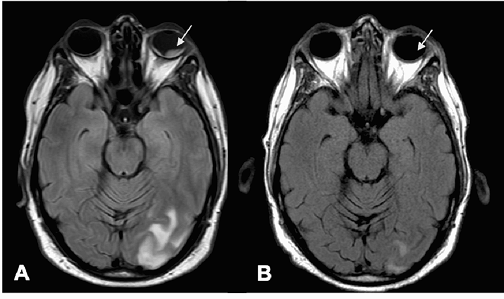 T2/FLAIR-brain-magnetic-resonance-imaging