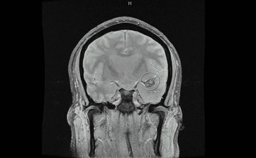 GRE-T2-Weighted-MRI-Brain:-Coronal-view