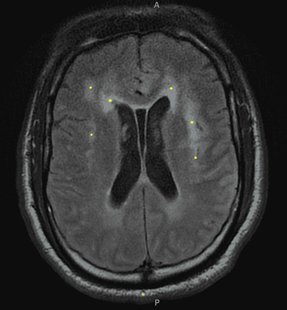 Axial-T2-FLAIR-MRI-Brain-prior-to-hemorrhagic-conversion