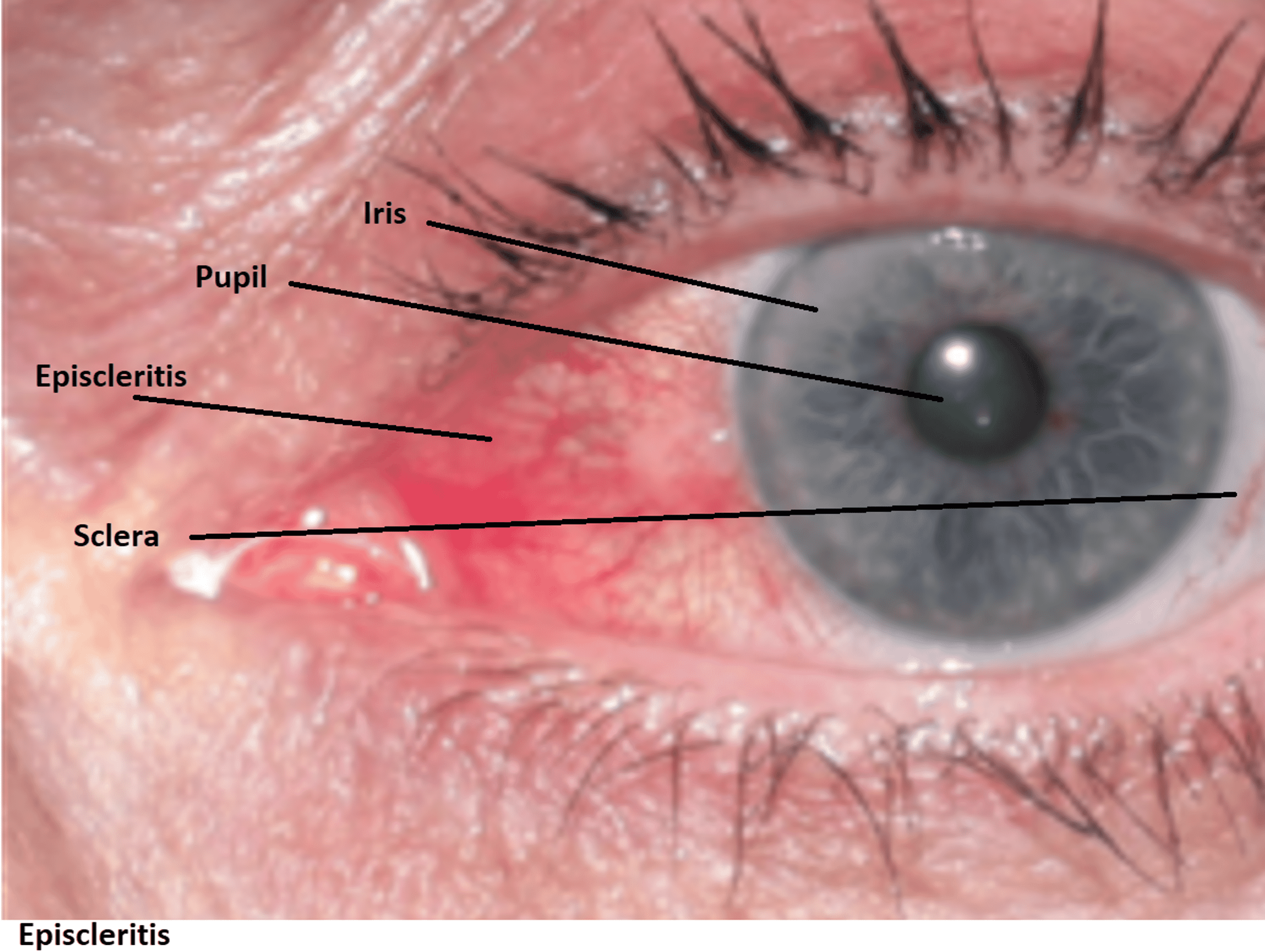 Cureus Reoccurring Episcleritis and the Role of Antioxidants