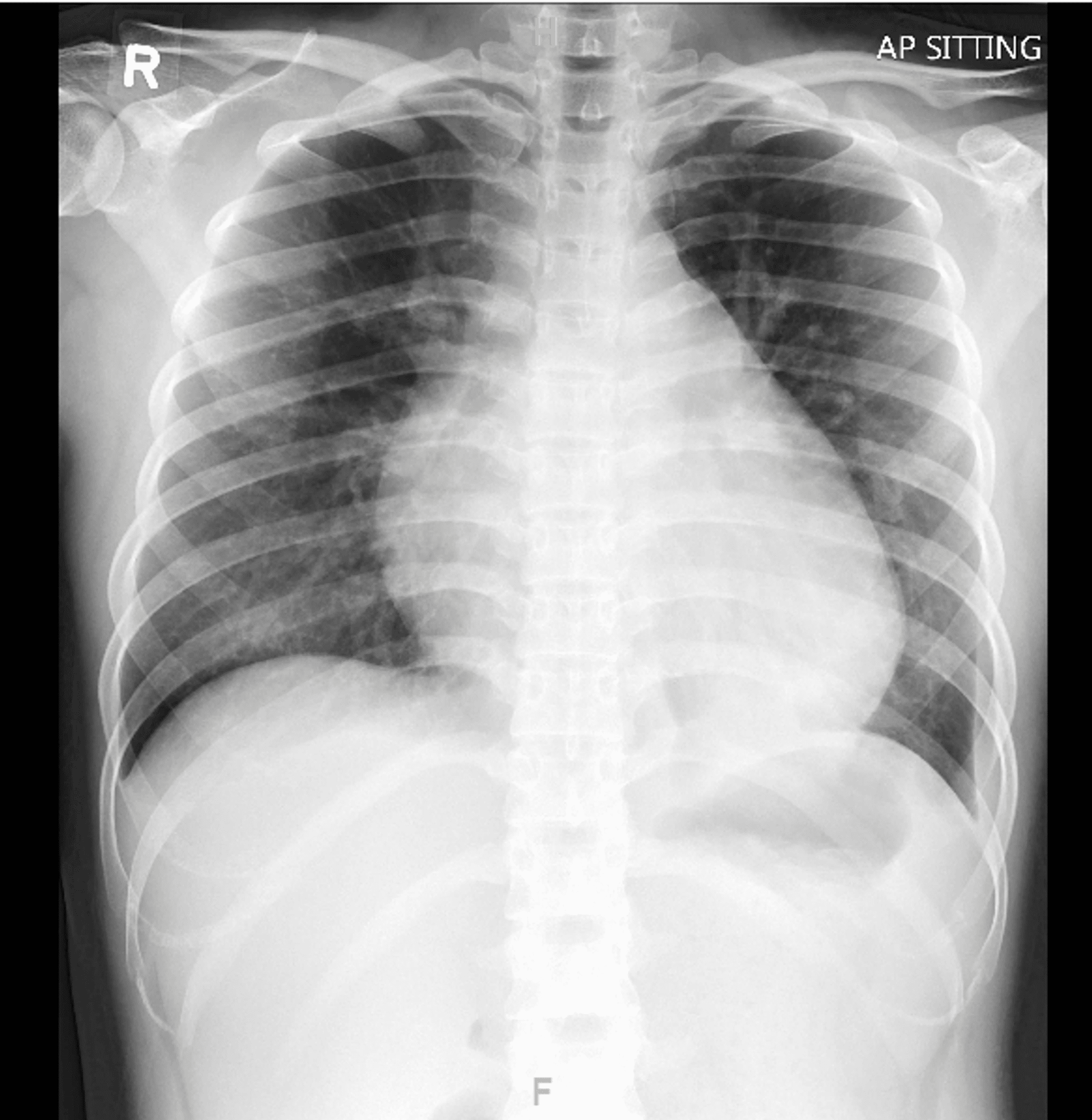 Beriberi A Reversible Cause of Acute Severe Pulmonary Hypertension
