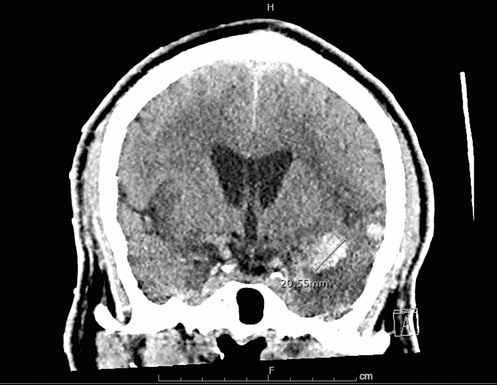 Non-contrast-computed-axial-tomography-of-the-head-showing-a-hemorrhage-in-the-left-temporal-lobe