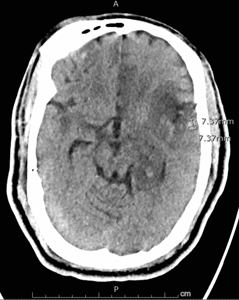 Non-contrast-computed-axial-tomography-scan-of-the-head-showing-a-hemorrhage,-measuring-7.37-x-7.37-x-7-mm-along-the-lateral-aspect-of-the-left-temporal-lobe.