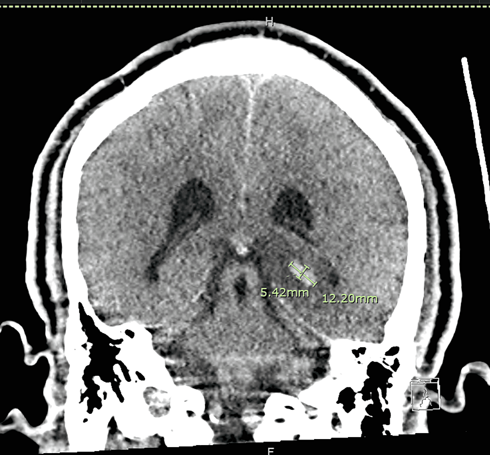 Non-contrast-computed-axial-tomography-of-the-head-showing-a-hemorrhage,-measuring-5-x-12-x-10-mm-along-the-posterior-medial-aspect-of-the-left-temporal-lobe.