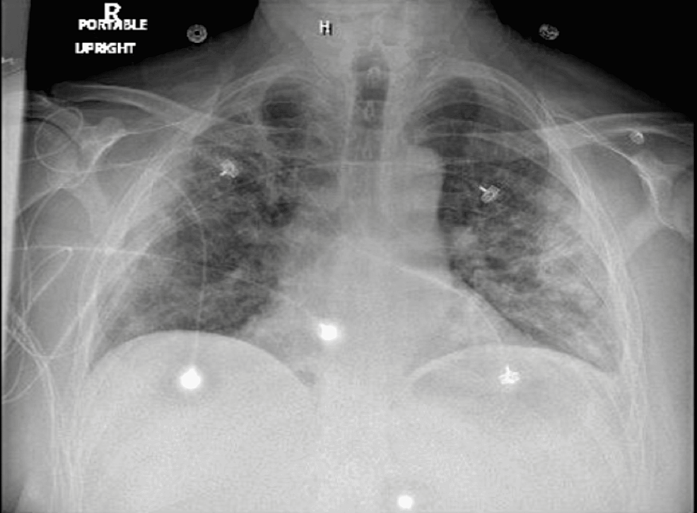 Chest-x-ray-showing-patchy-and-confluent-parenchymal-infiltrates-throughout-the-lungs.