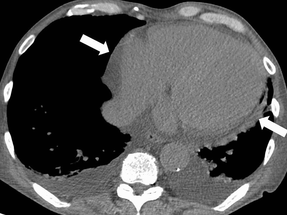 Pericardial-effusion-on-the-initial-computed-tomography