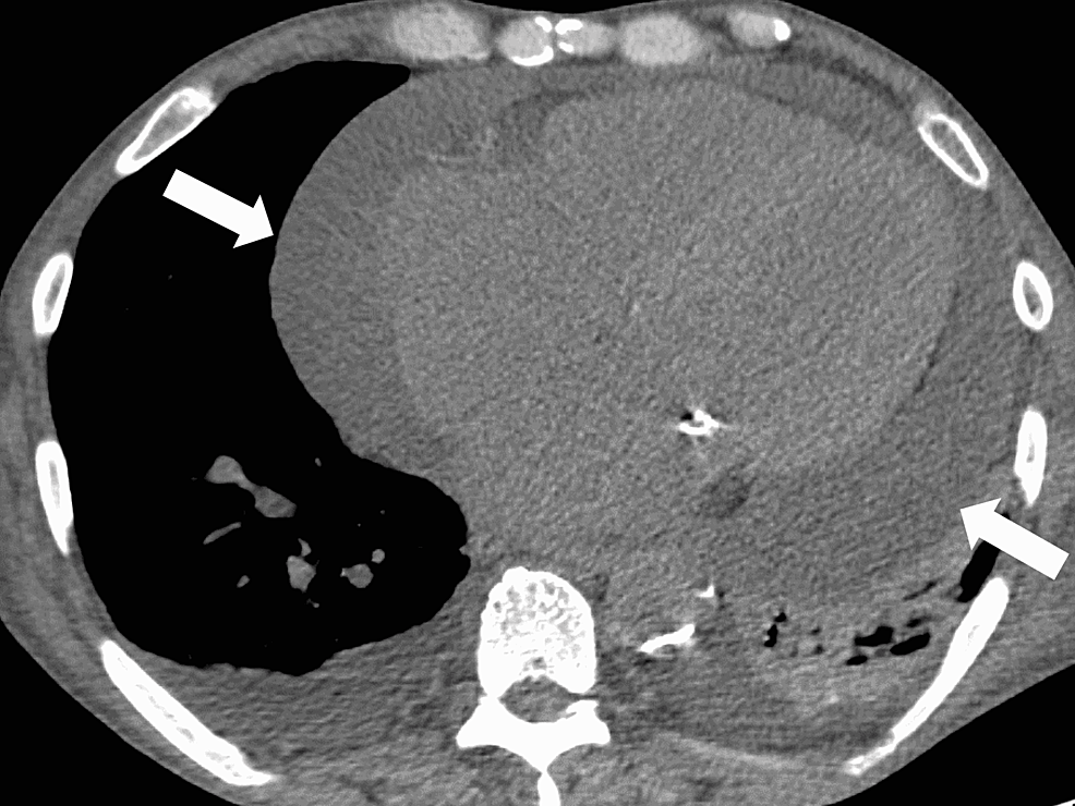 Cardiac-tamponade-on-the-subsequent-computed-tomography