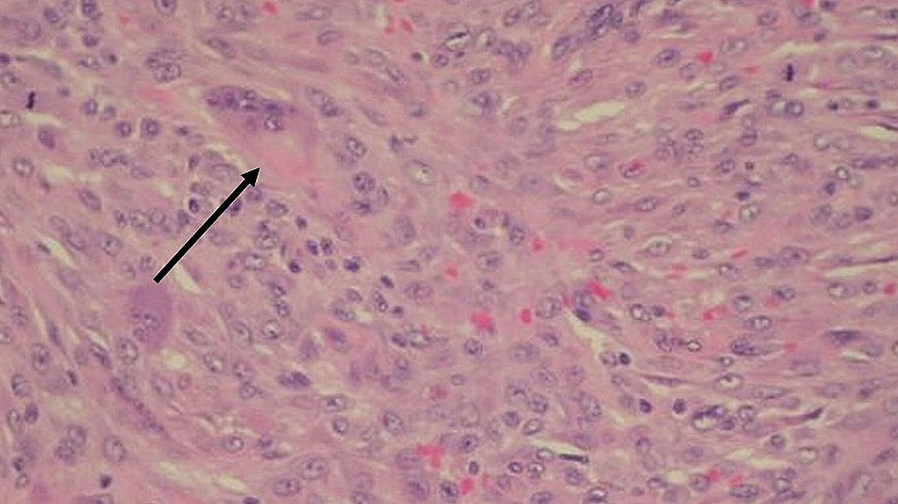 Cureus A Vascularappearing Spindle Cell Xanthogranuloma in a Child