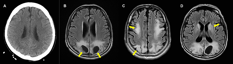 Cureus | Cystic Encephalomalacia in a Young Woman After Cardiac Arrest ...