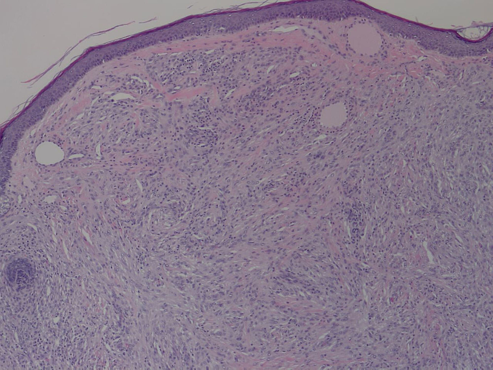 Cureus A Vascularappearing Spindle Cell Xanthogranuloma in a Child