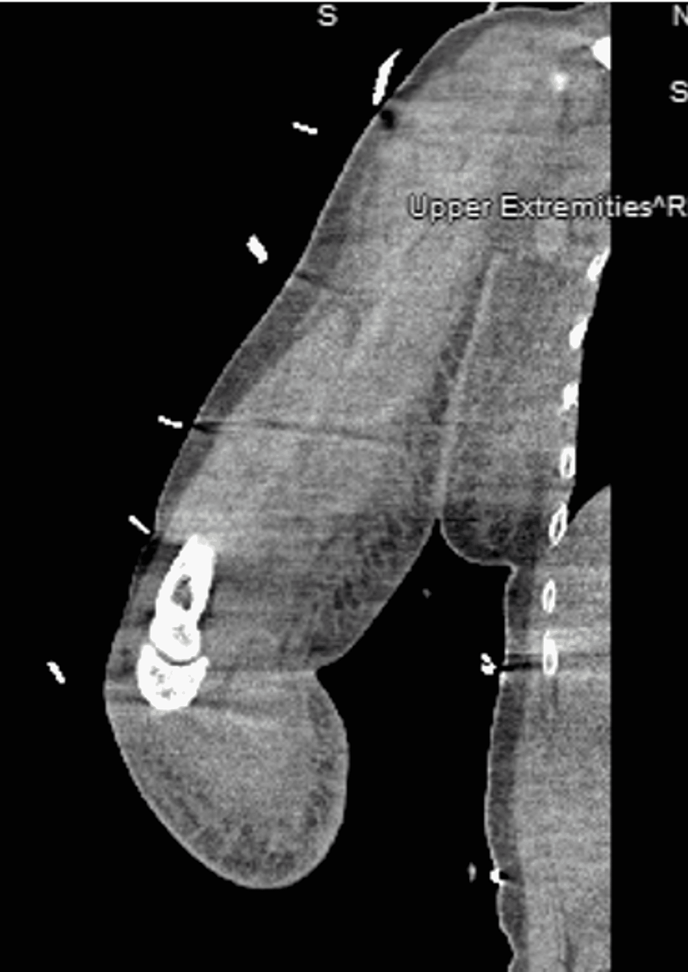 CT-without-contrast-of-the-right-upper-extremity.
