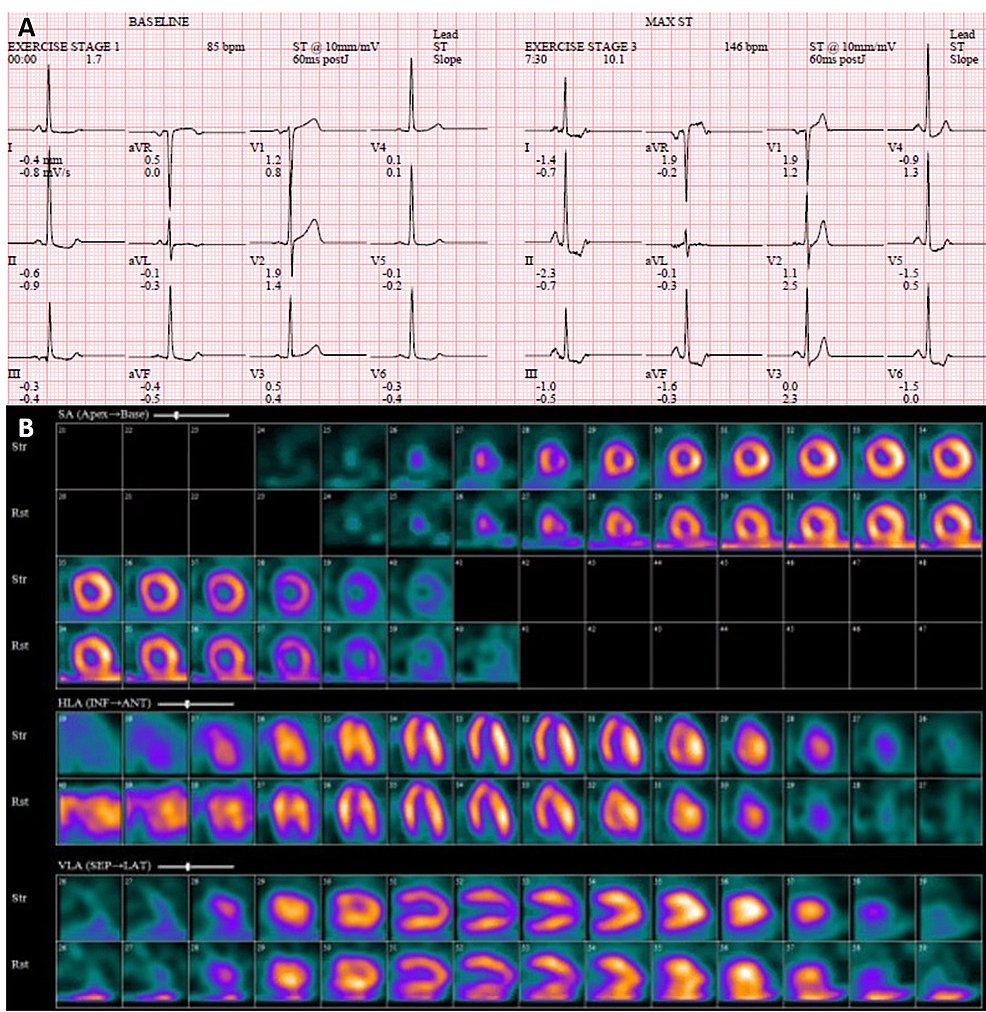 Cureus | Limitations Of Coronary Computed Tomography Angiography In ...